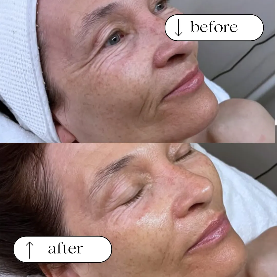 Before and after — fine lines and sun damage around the eye and cheek