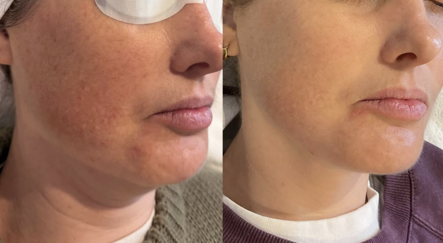 Before and after — redness and pigmentation on the cheek and jawline