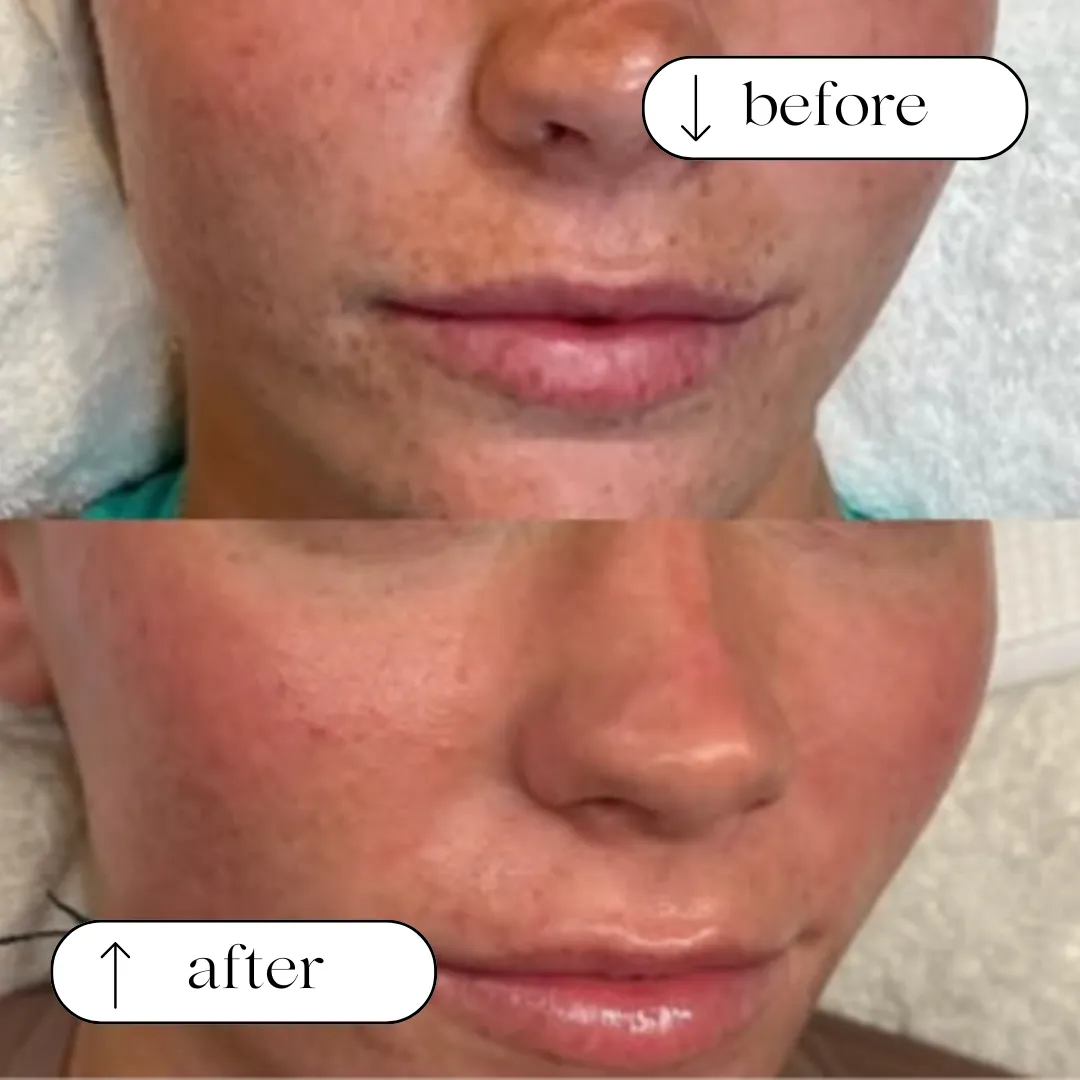 Before and after — pigmentation and texture across the cheek and jawline
