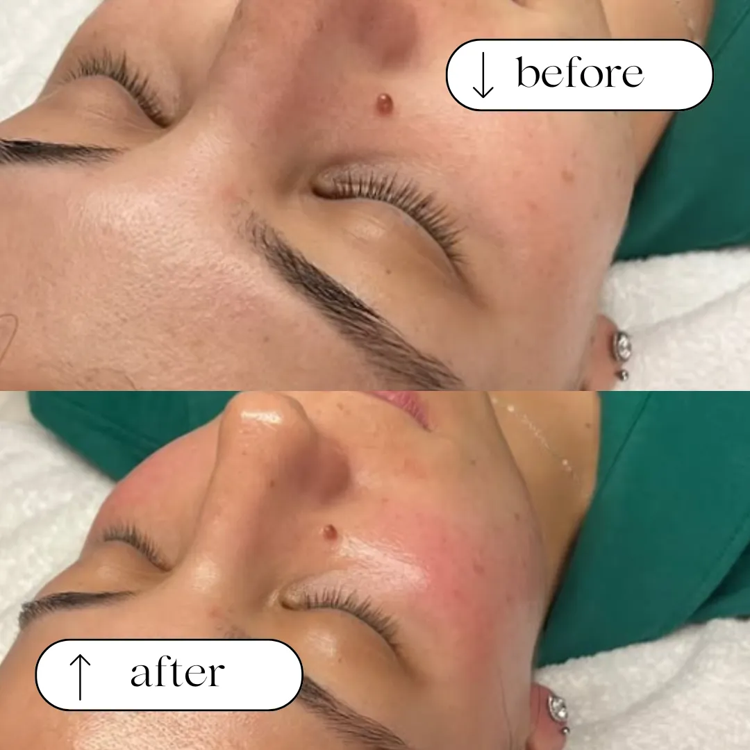 Before and after — congestion and breakouts around the nose and brow